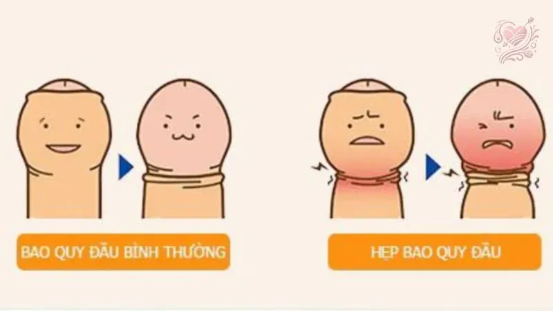 Nguyên nhân bị hẹp bao quy đầu
