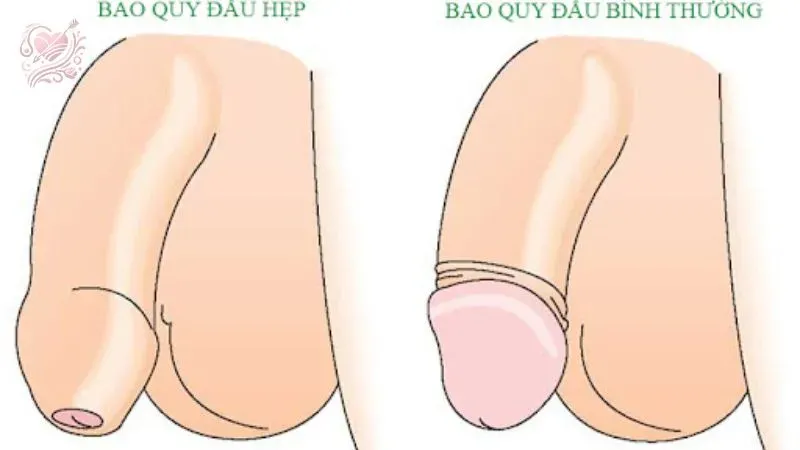 Hẹp bao quy đầu là gì?