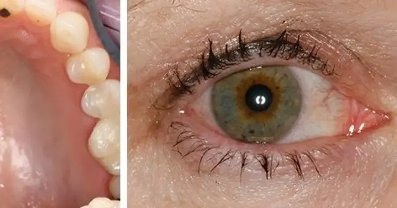 Nguyên nhân gây ra hội chứng Sjogren 1