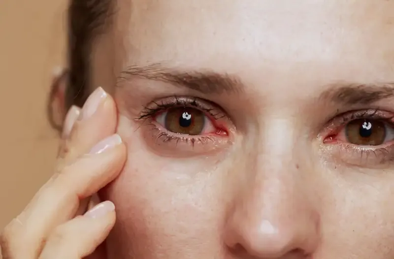Cách phòng ngừa hội chứng Sjogren 1