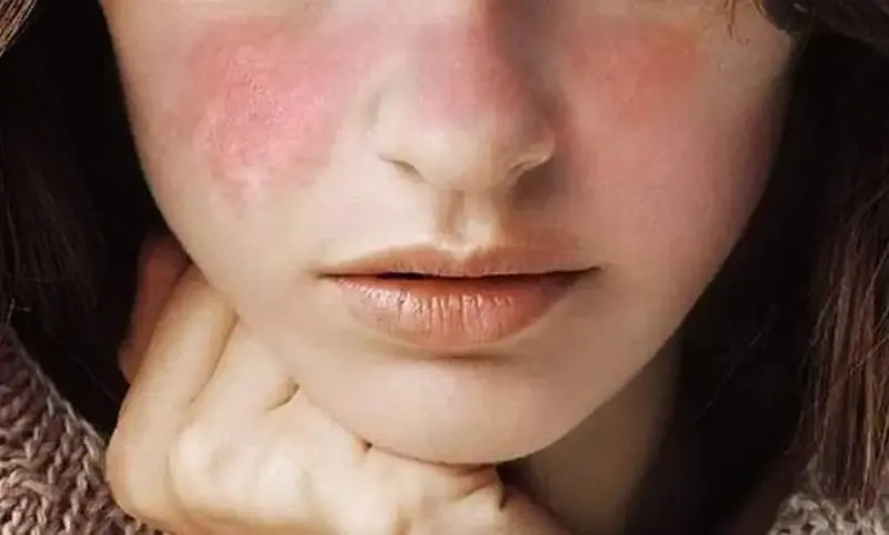Cách phòng ngừa hội chứng Sjogren 2