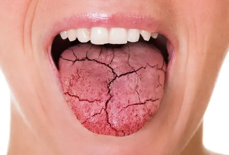 Cách phòng ngừa hội chứng Sjogren 3