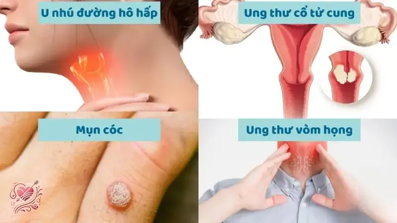 Dấu hiệu nhiễm HPV