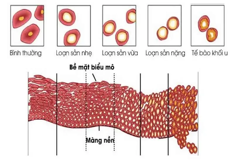 Các giai đoạn của bệnh loạn sản cổ tử cung 3