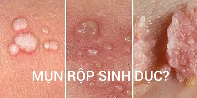 Mức độ nguy hiểm của mụn rộp sinh dục 1