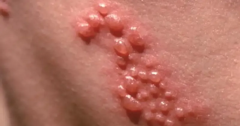 Mức độ nguy hiểm của mụn rộp sinh dục 2