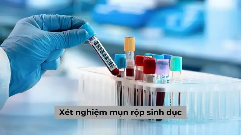 Các phương pháp chữa mụn rộp sinh dục 2