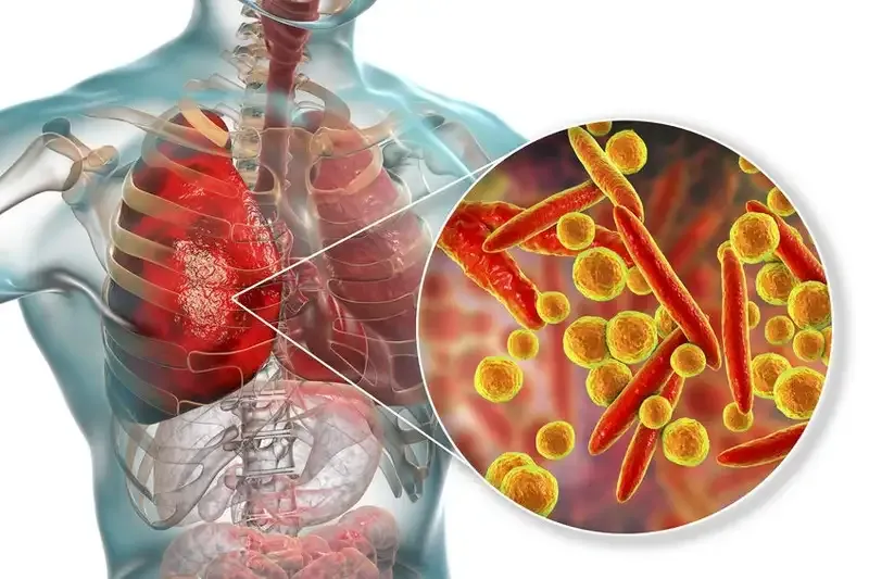 Mycoplasma Genitalium là bệnh gì?
