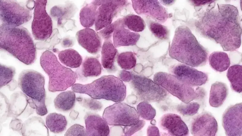 Nguyên nhân gây bệnh Mycoplasma Genitalium 1