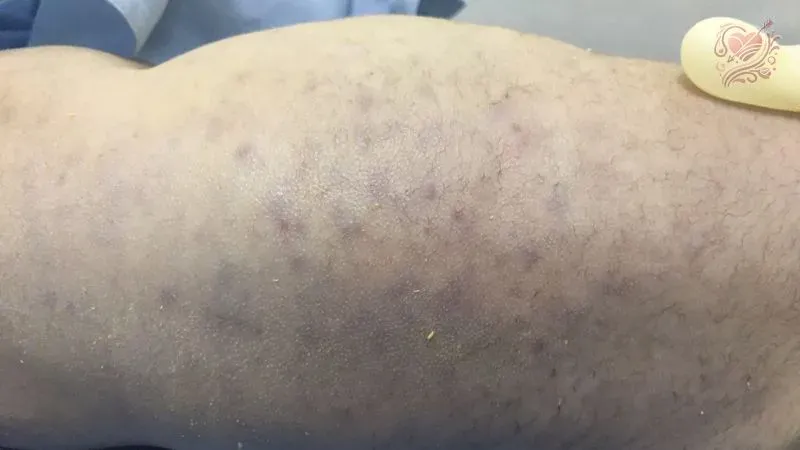 Cách phòng ngừa bệnh Cytomegalovirus