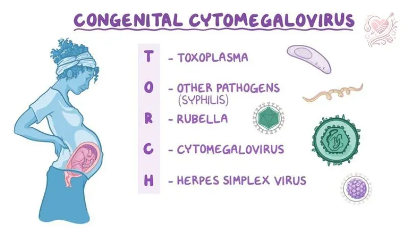 Triệu chứng của nhiễm Cytomegalovirus (CMV)