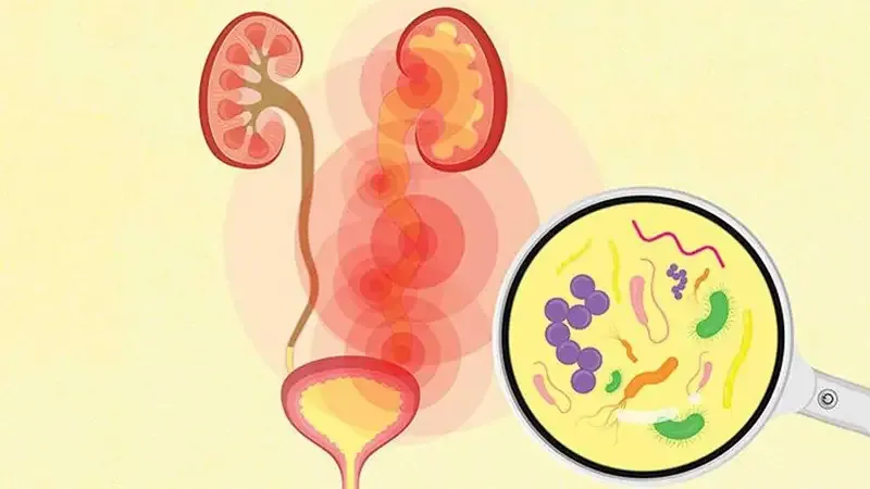 Triệu chứng của nhiễm trùng đường tiết niệu