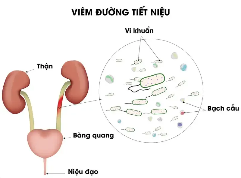 Cách phòng chống tái nhiễm trùng đường tiết niệu 2