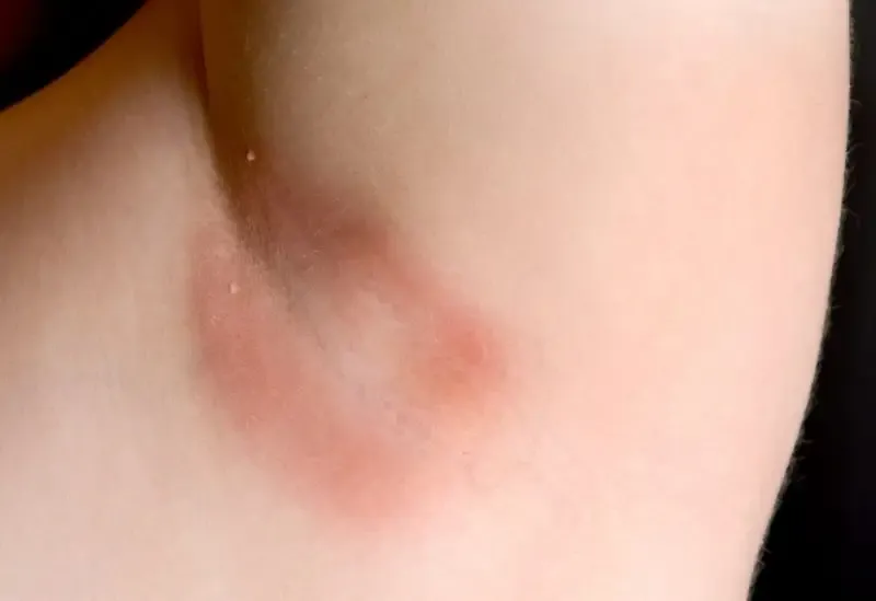 Nguyên nhân bệnh nấm nhiễm trùng nấm men 1