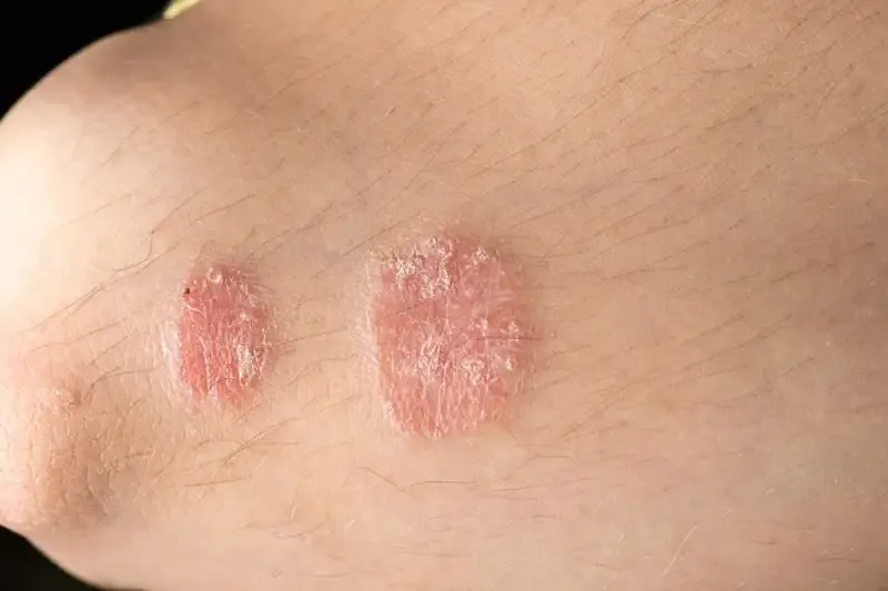 Triệu chứng của bệnh nhiễm trùng nấm men 1