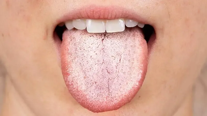 Triệu chứng của bệnh nhiễm trùng nấm men 2