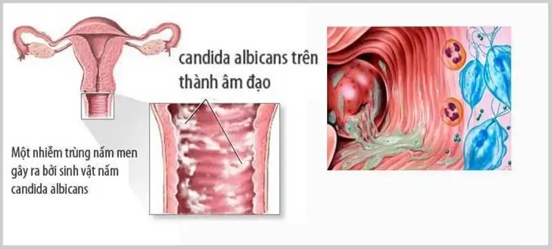 Đối tượng có nguy cơ mắc bệnh nhiễm nấm Candida 1