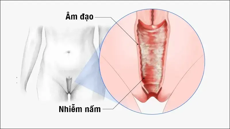 Đường lây truyền của bệnh nhiễm trùng nấm men
