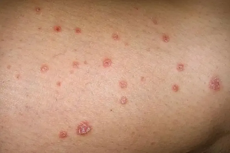 Các biện pháp điều trị bệnh nhiễm nấm Candida 2
