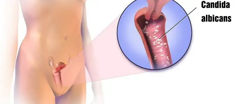 Phòng ngừa bệnh nhiễm trùng nấm men 3