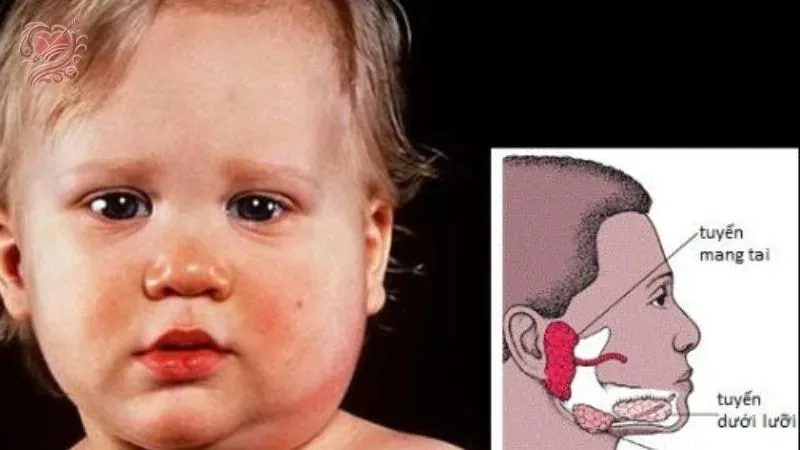 Bị quai bị có vô sinh không? Vì sao?