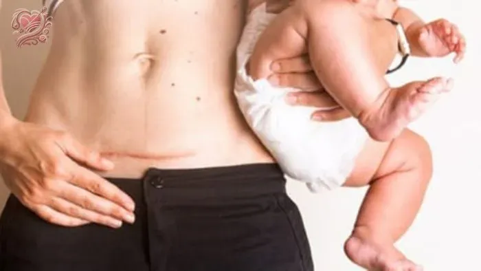 Sinh mổ là gì?