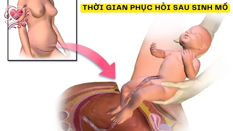 Thời gian phục hồi sau sinh mổ