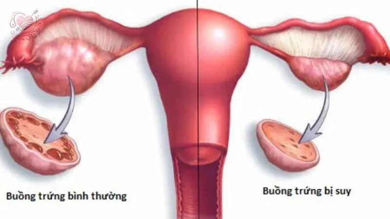 Suy buồng trứng là gì?