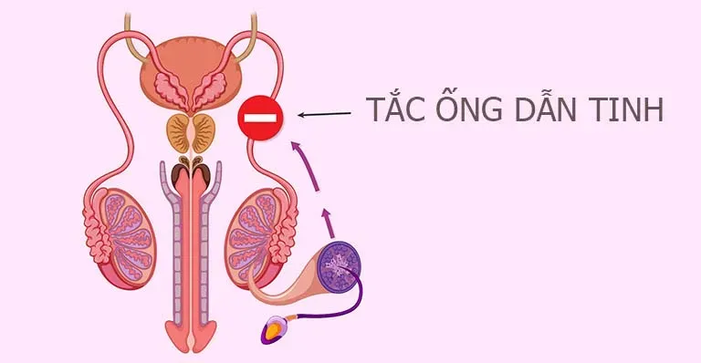 Thắt ống dẫn tinh có quan hệ được không?