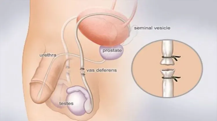 Những lợi ích và hạn chế của thắt ống dẫn tinh