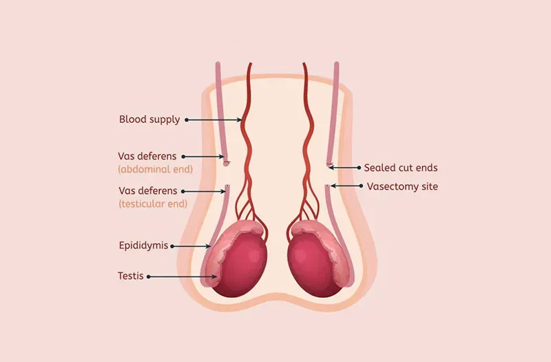 Mất bao lâu để sinh hoạt bình thường sau khi thắt ống dẫn tinh?