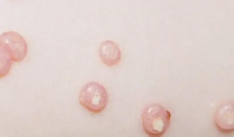 Triệu chứng của u mềm lây