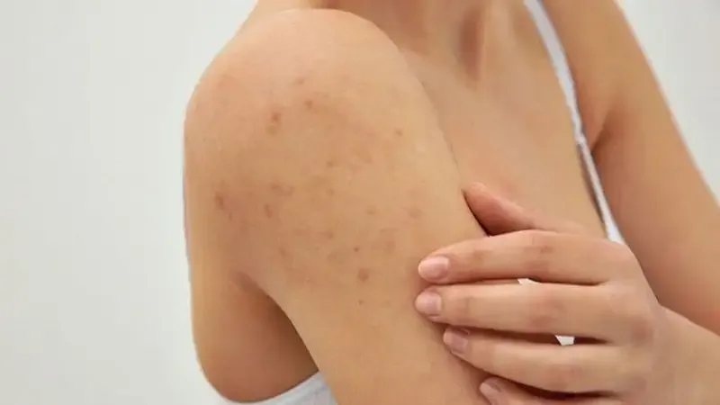 Phương pháp điều trị u mềm lây