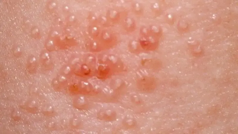Phương pháp điều trị u mềm lây 2