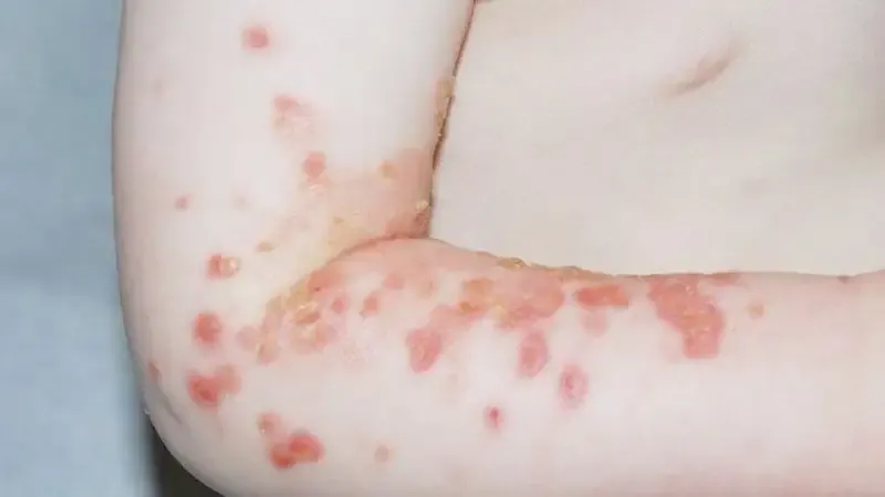Phương pháp phòng ngừa u mềm lây 3