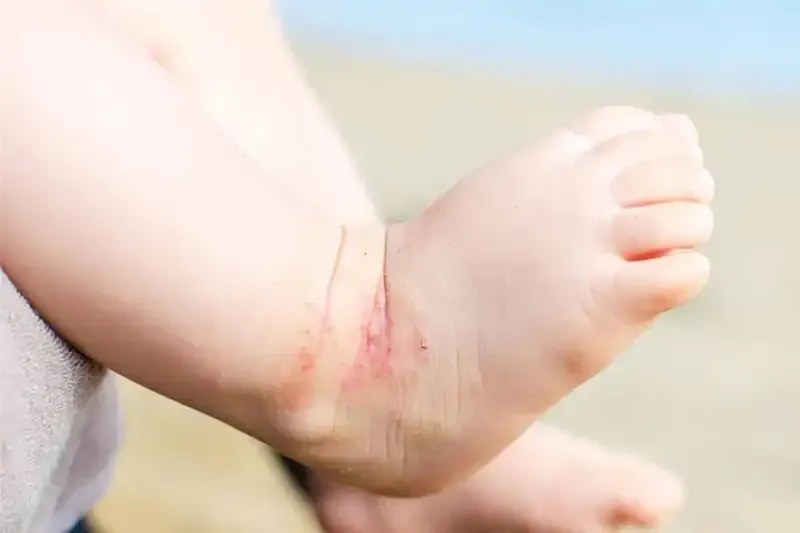 Phương pháp phòng ngừa u mềm lây 2