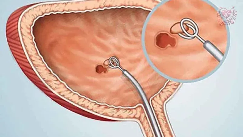 Cách phòng ngừa viêm bàng quang kẽ sau điều trị