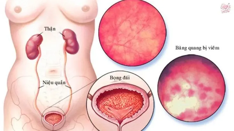 Phương pháp điều trị viêm bàng quang kẽ