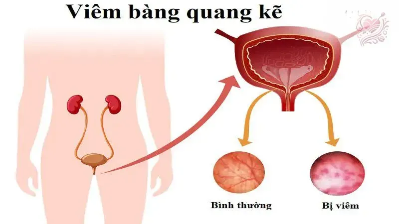 Nguyên nhân gây ra viêm bàng quang kẽ?