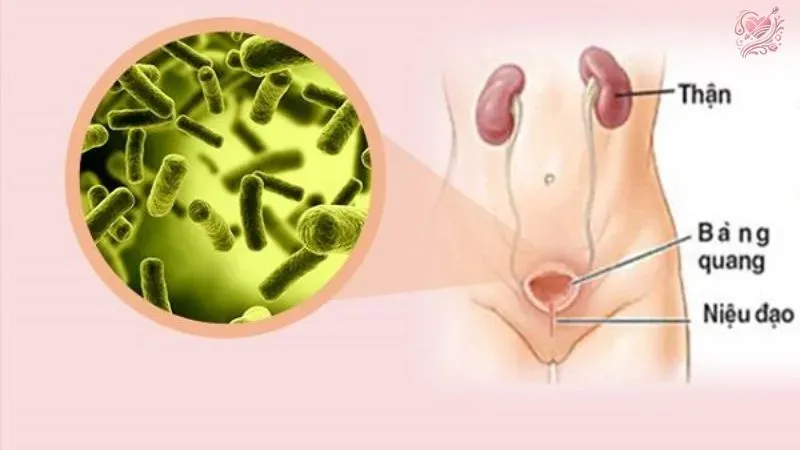 Viêm bàng quang kẽ là gì?