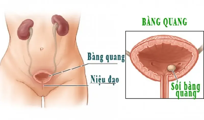 Nguyên nhân gây bệnh viêm bàng quang