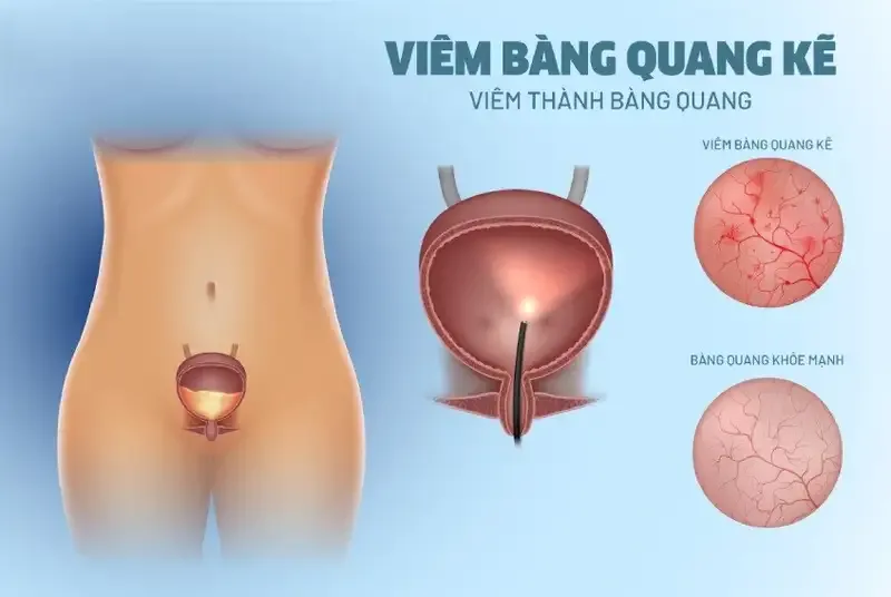 Dấu hiệu khi mắc bệnh viêm bàng quang