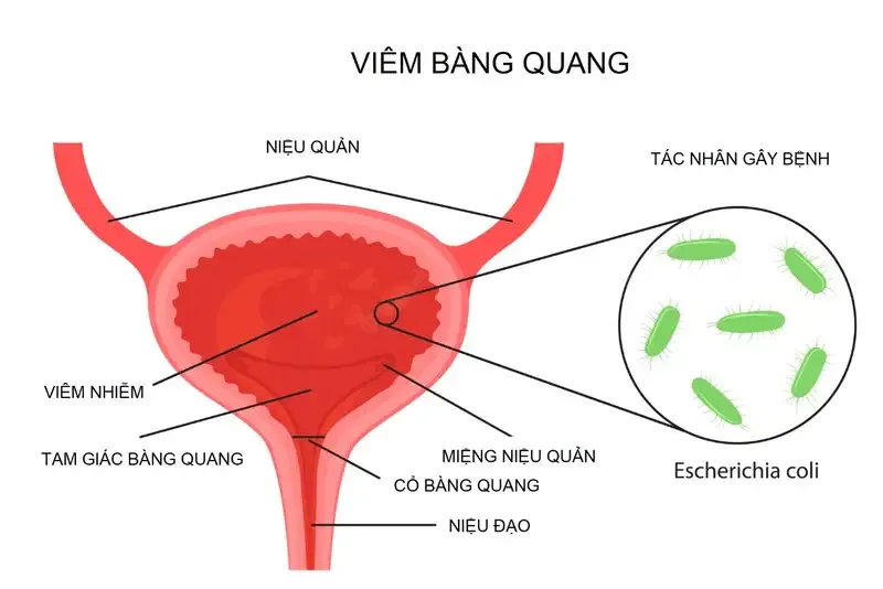 Phương pháp điều trị bệnh viêm bàng quang 2