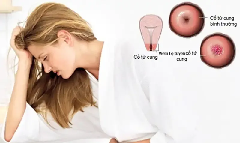 Viêm cổ tử cung là gì?