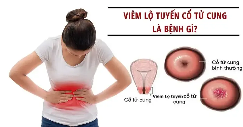 Triệu chứng của bệnh viêm cổ tử cung