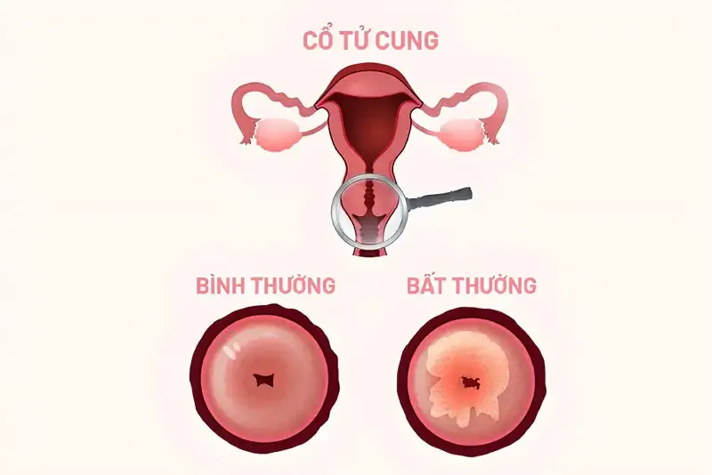 Nguyên nhân gây bệnh viêm cổ tử cung 2