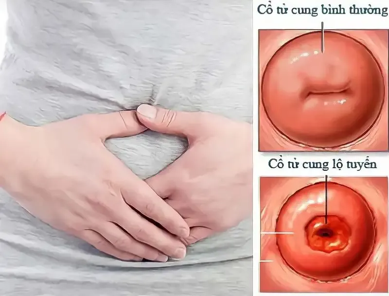 Chẩn đoán bệnh viêm cổ tử cung 1