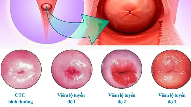 Chẩn đoán bệnh viêm cổ tử cung 2