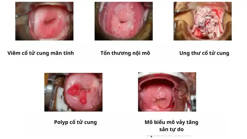 Chẩn đoán bệnh viêm cổ tử cung 3