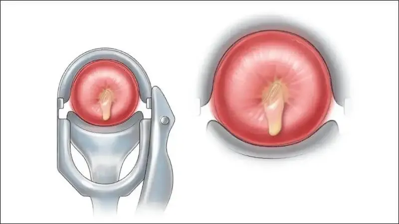 Cách điều trị bệnh viêm cổ tử cung